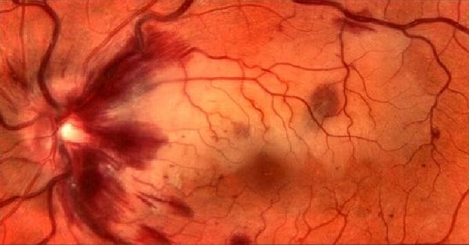 Blood courts of retina and visual renovation